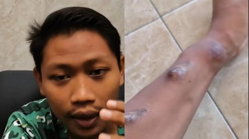 Kisah Inspiratif Edi Utomo, Pemuda Tuban yang Berjuang Lawan Gagal Ginjal Stadium 5 Sejak Remaja